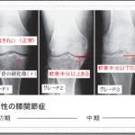 変形性膝関節症の治療院