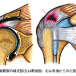 肩腱板損傷とは？原因と症状と治し方理学療法士が解説します【動画解説付】