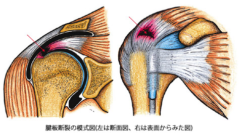 腱板損傷の写真